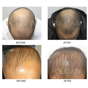 Maximizing Hair Regrowth: The Pros and Cons of Combining Minoxidil with Other Hair Loss Treatments