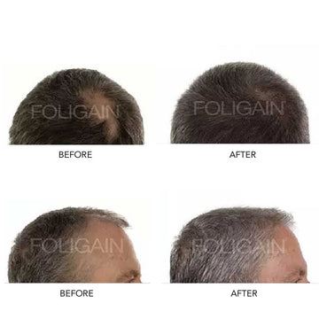 The Best Minoxidil Routine for Optimal Results