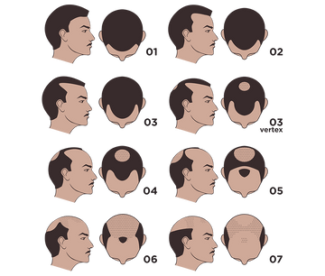 What is The Hamilton-Norwood Scale?